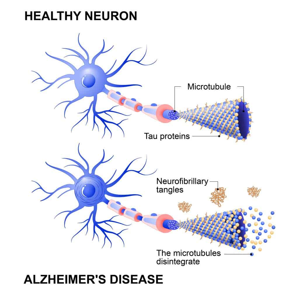 Key differences between primary age related tauopathy and alzheimer s