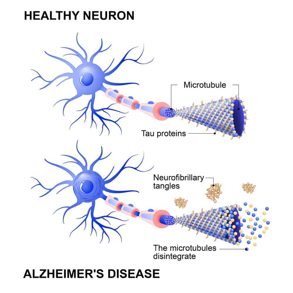 A graphic showing how tau tangles affect the neurons of those with Alzheimer’s disease.