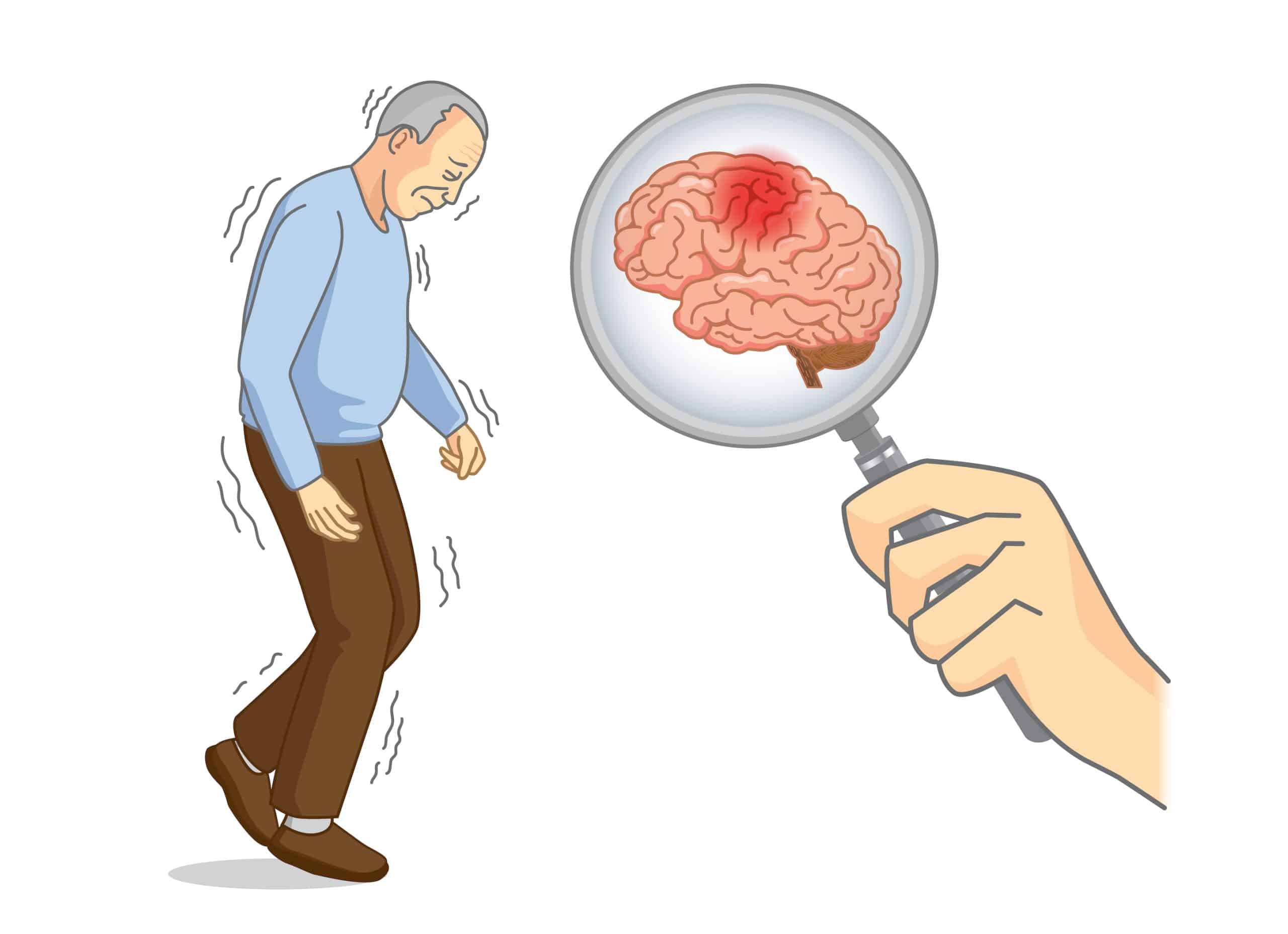 De ziekte van Parkinson is een van de meest voorkomende neurologische aandoeningen.