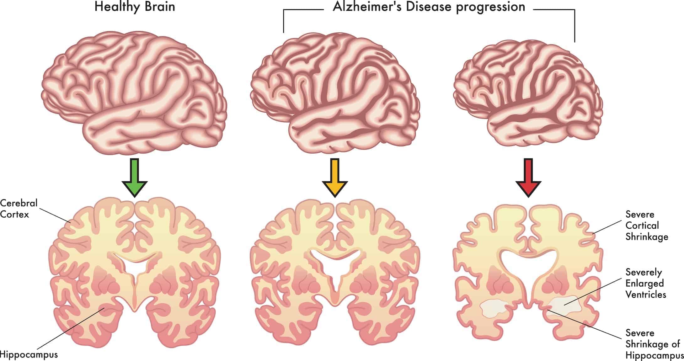 Understanding the Stages and Progression of Alzheimer’s Disease
